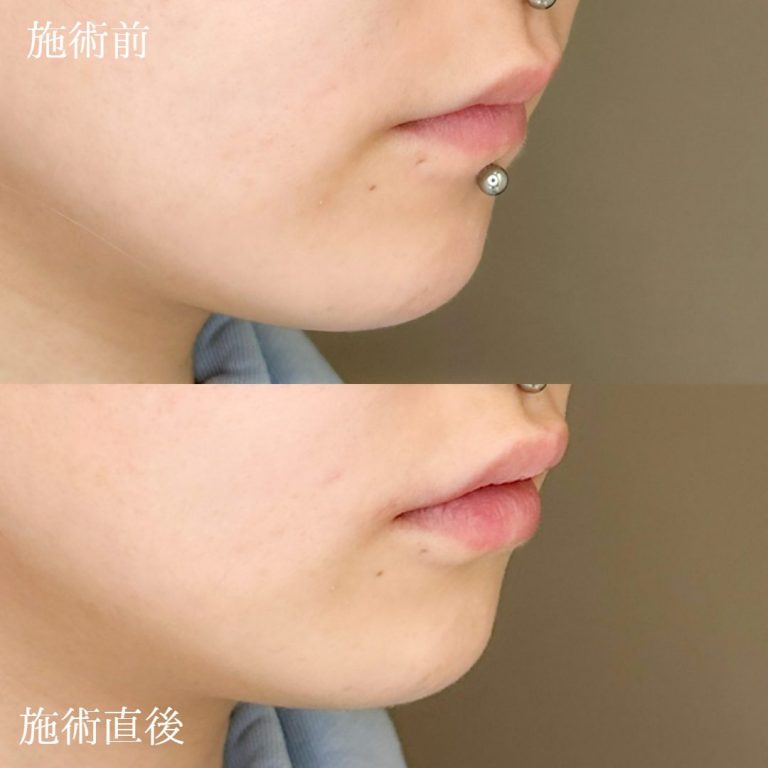 唇のヒアルロン酸注射(担当医:TCB 医師)の症例写真1