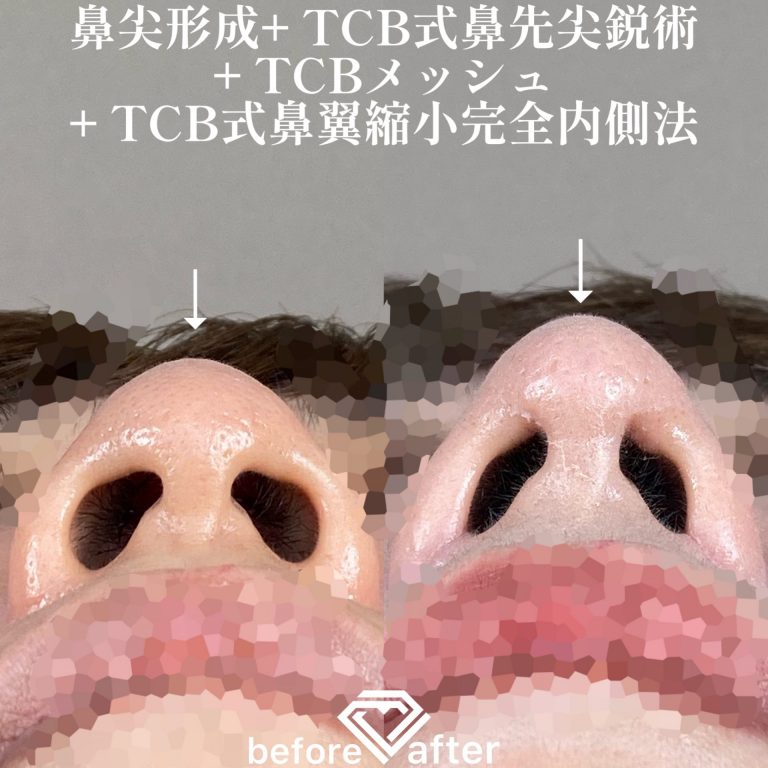 鼻尖形成(担当医:TCB 医師)の症例写真2