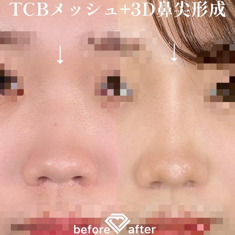 鼻尖形成(担当医:TCB 医師)の症例写真1