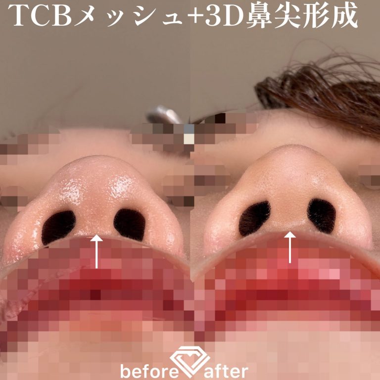 鼻尖形成(担当医:TCB 医師)の症例写真2