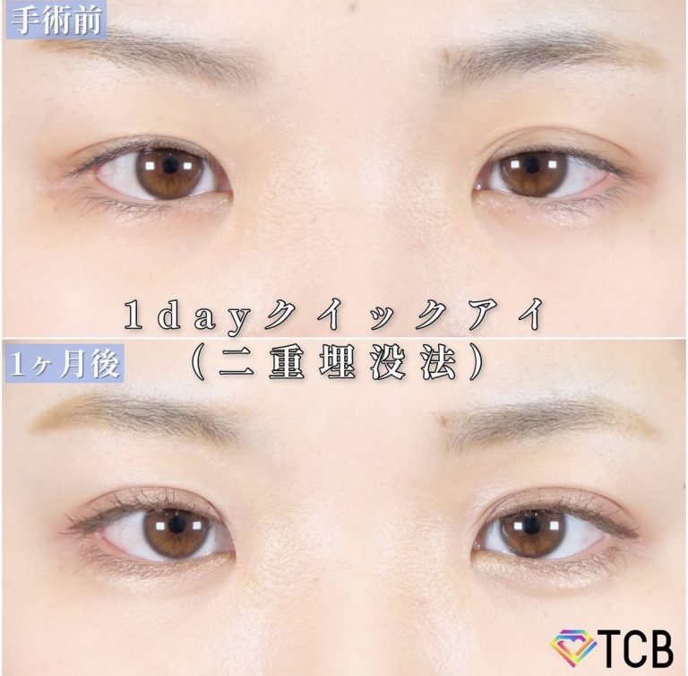 二重埋没法(担当医:TCB 医師)の症例写真1