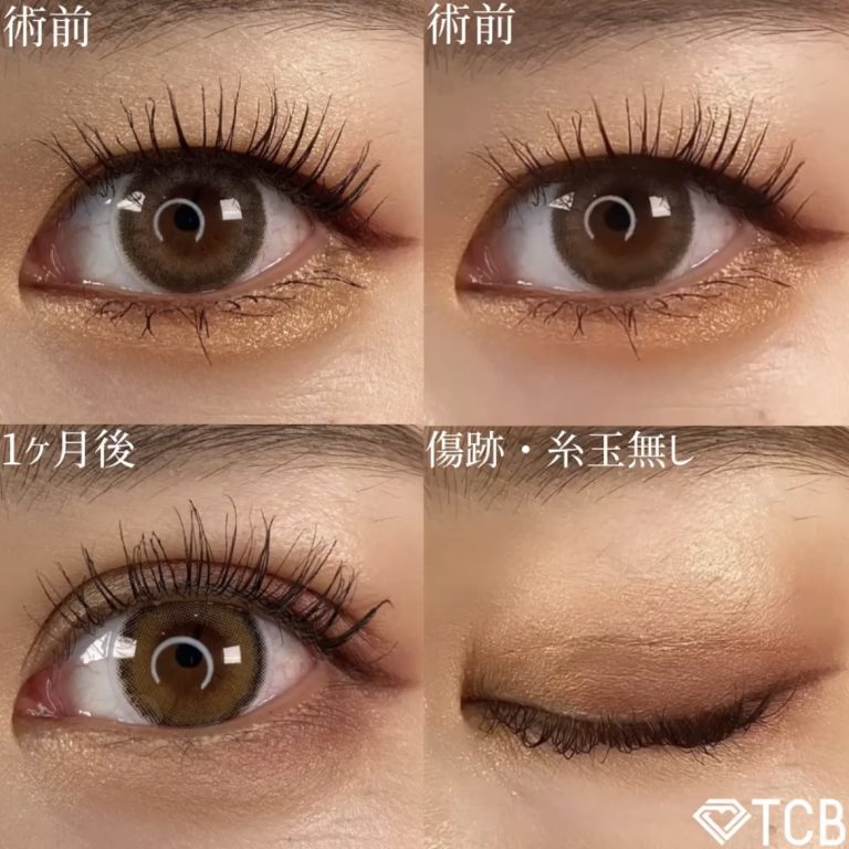 二重埋没法(担当医:TCB 医師)の症例写真2