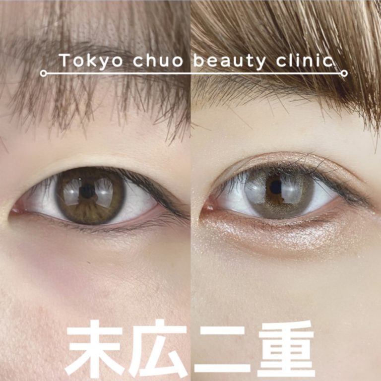 二重埋没法(担当医:TCB 医師)の症例写真3