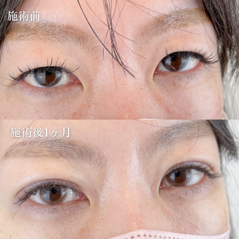 二重埋没法(担当医:TCB 医師)の症例写真3