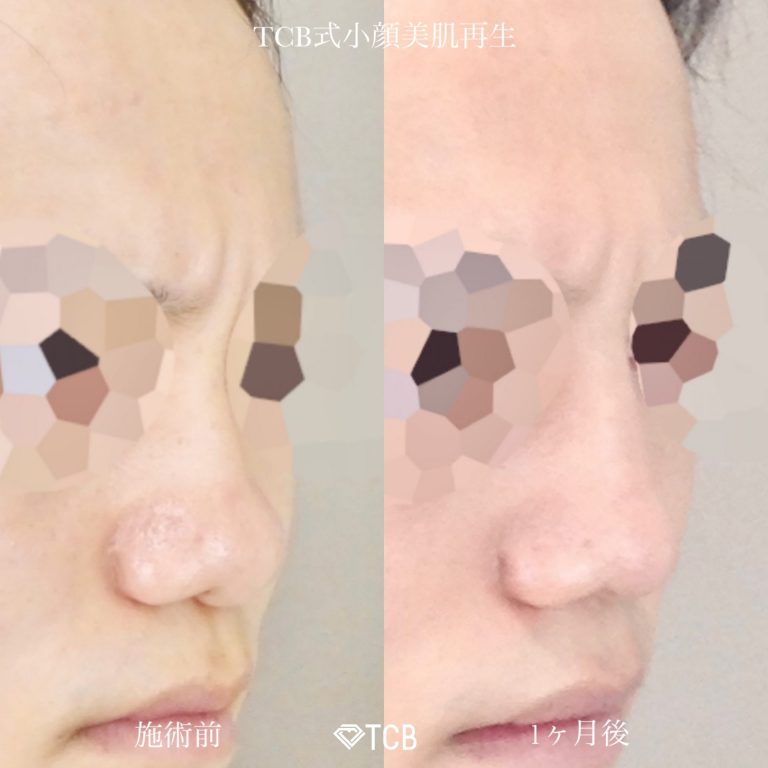 鼻尖形成(担当医:佐藤 麻未 医師)の症例写真2