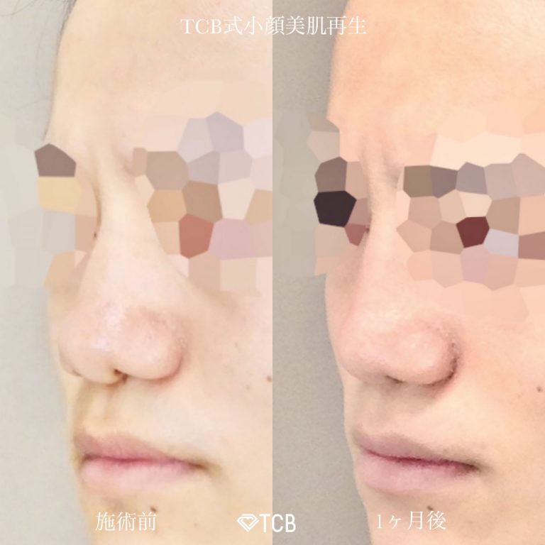 鼻尖形成(担当医:佐藤 麻未 医師)の症例写真1