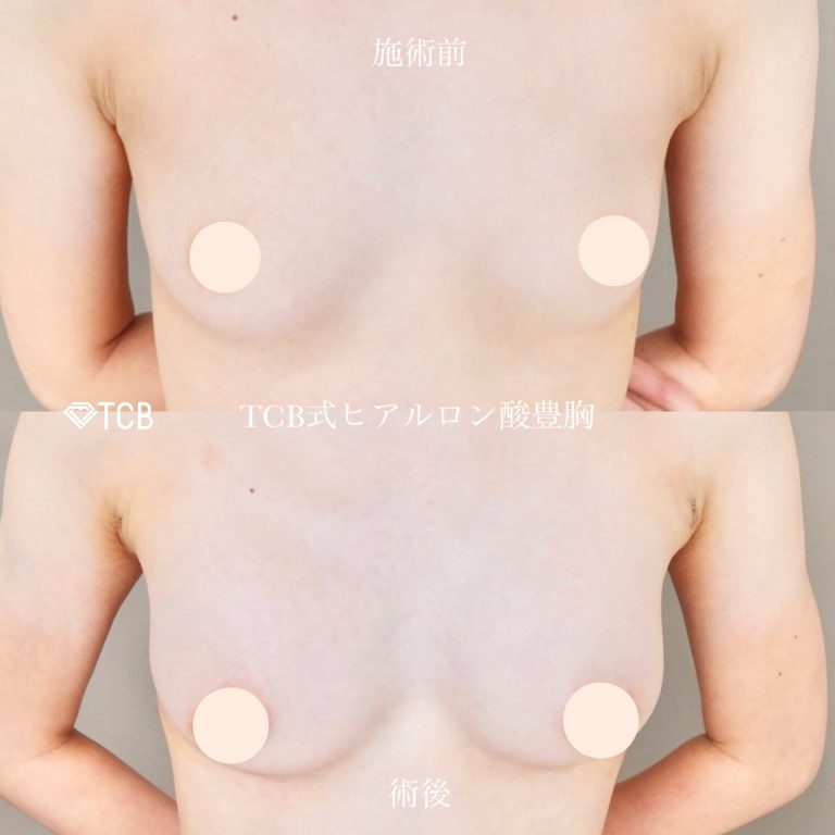 TCB式ヒアルロン酸豊胸(担当医:佐藤 麻未 医師)の症例写真1