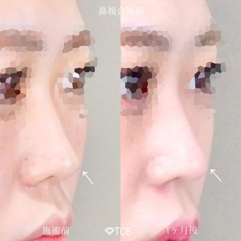 鼻尖形成完全閉鎖法（切らない鼻尖形成）(担当医:佐藤 麻未 医師)の症例写真2