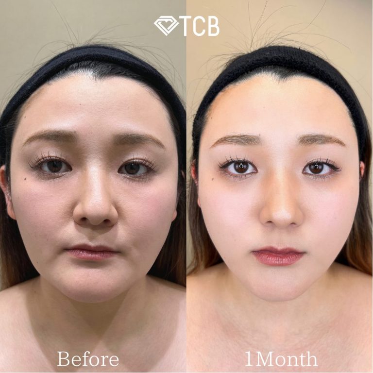 TCB式小顔脂肪吸引(担当医:鎌田 紀美子 医師)の症例写真1