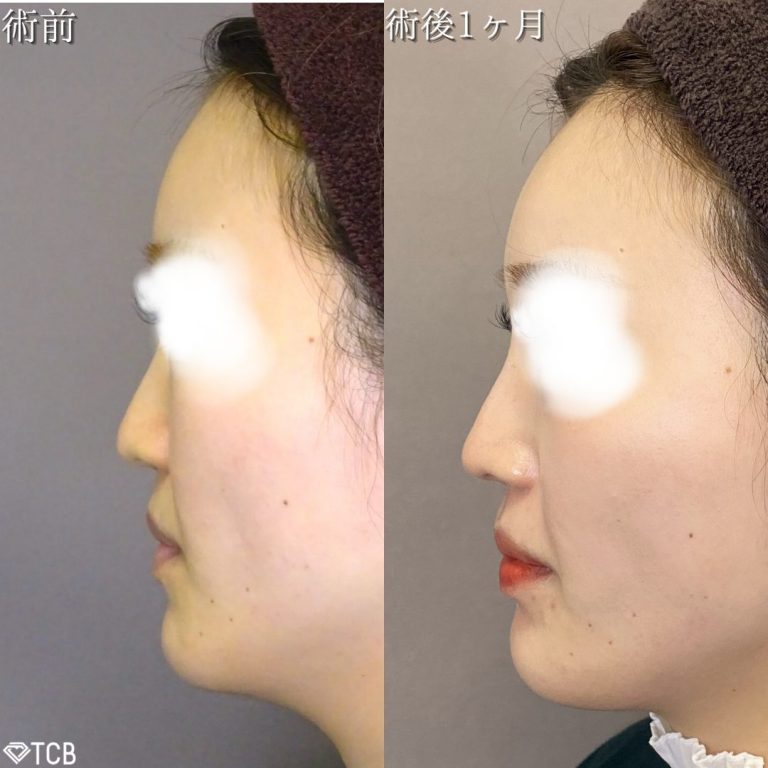 鼻尖形成(担当医:TCB 医師)の症例写真2