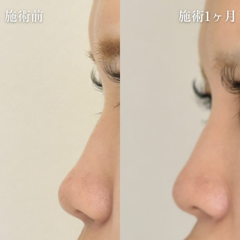 TCB式鼻先尖鋭術（だんご鼻解消）(担当医:TCB 医師)の症例写真2