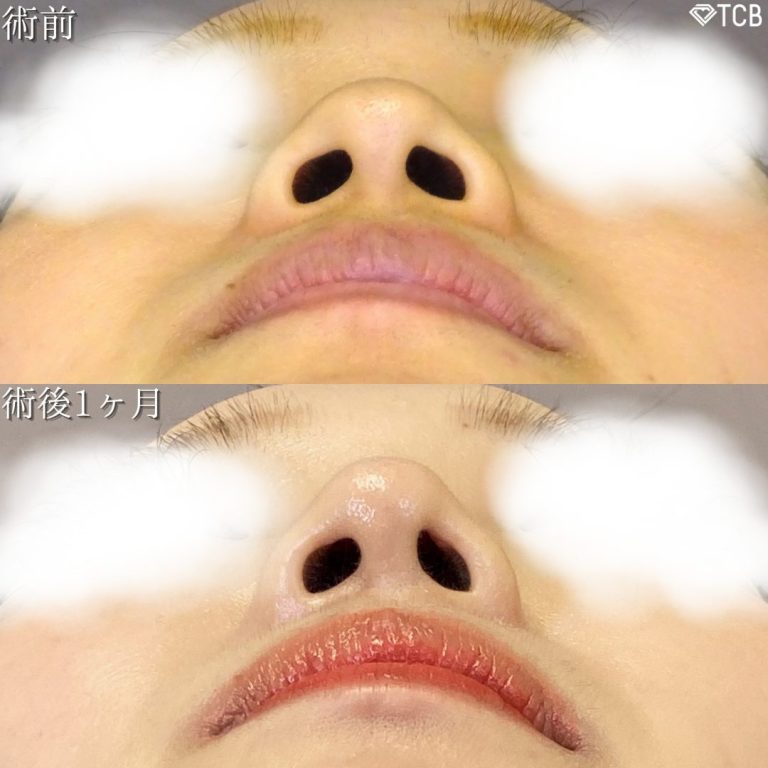 鼻尖形成(担当医:TCB 医師)の症例写真3
