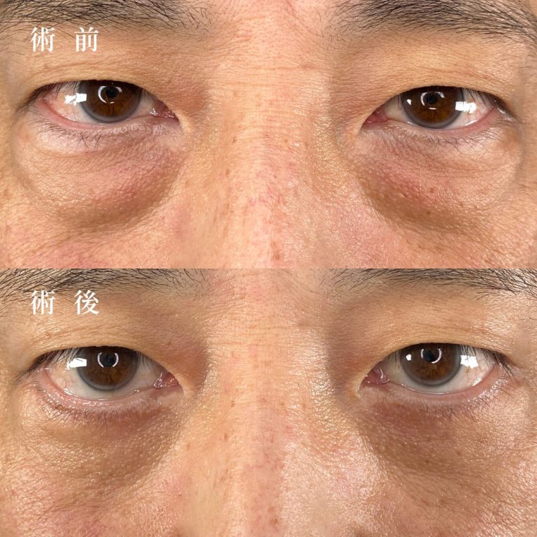 切開法による目の下のたるみ取り（下眼瞼除皺術）(担当医:真鍋 秀明 医師)の症例写真1
