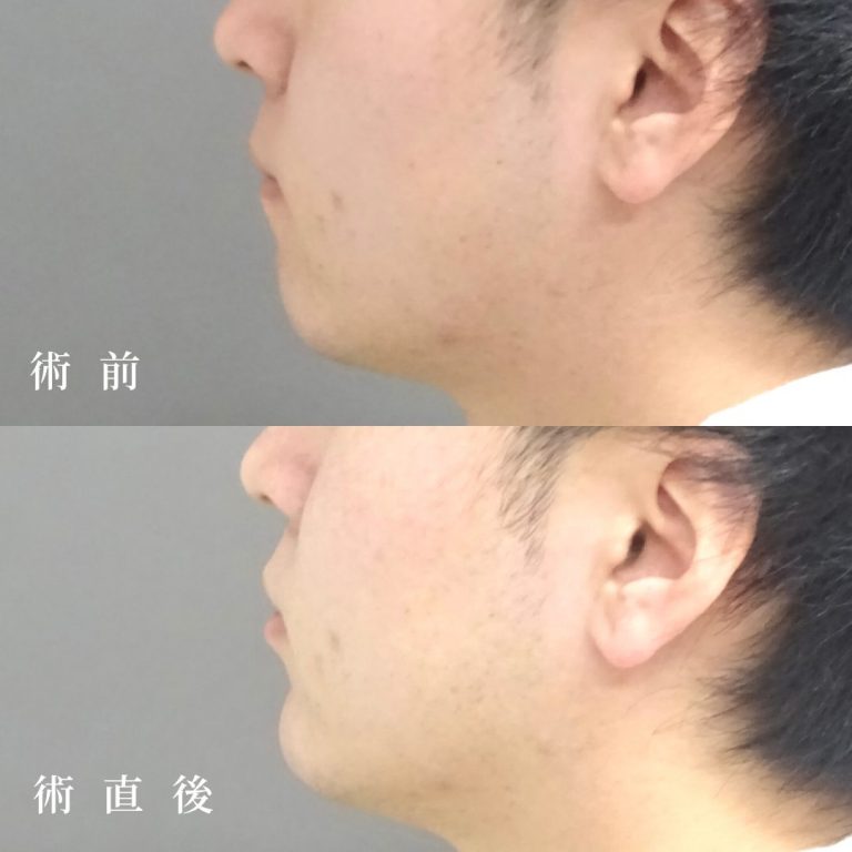 顎（あご）のヒアルロン酸注射(担当医:真鍋 秀明 医師)の症例写真2