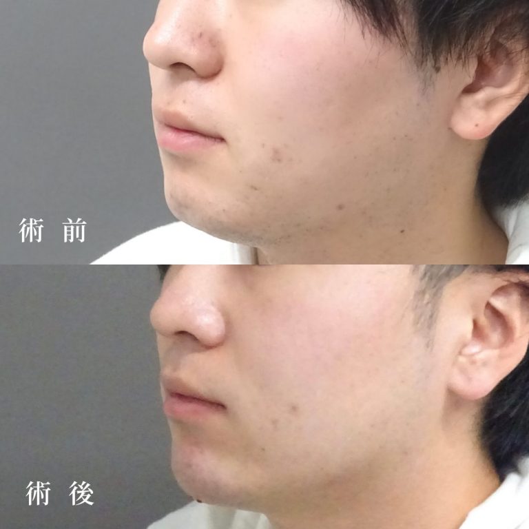 顎（あご）のヒアルロン酸注射(担当医:真鍋 秀明 医師)の症例写真1