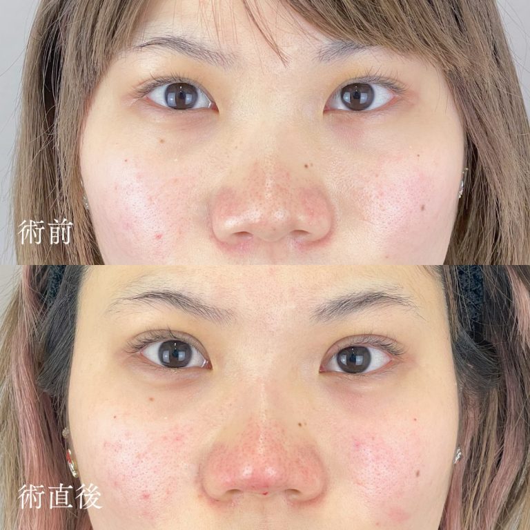 二重埋没法(担当医:TCB 医師)の症例写真1