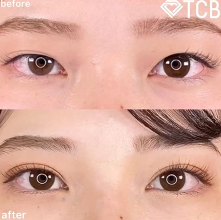 二重埋没法(担当医:TCB 医師)の症例写真1