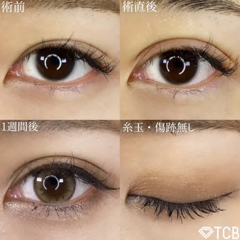 二重埋没法(担当医:TCB 医師)の症例写真1