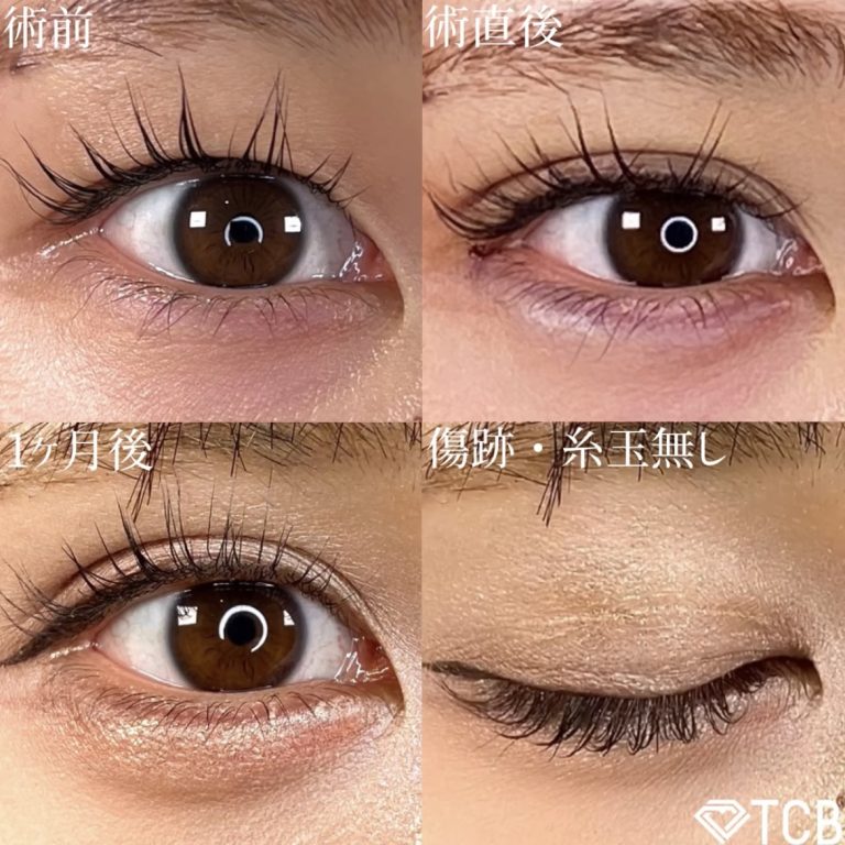 二重埋没法(担当医:TCB 医師)の症例写真1