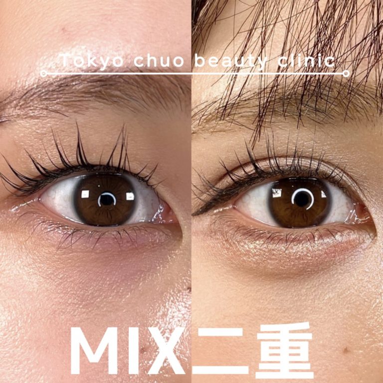 二重埋没法(担当医:TCB 医師)の症例写真3