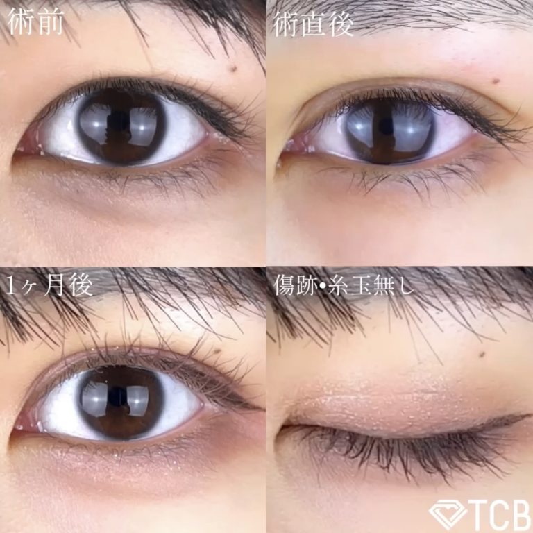 二重埋没法(担当医:TCB 医師)の症例写真1