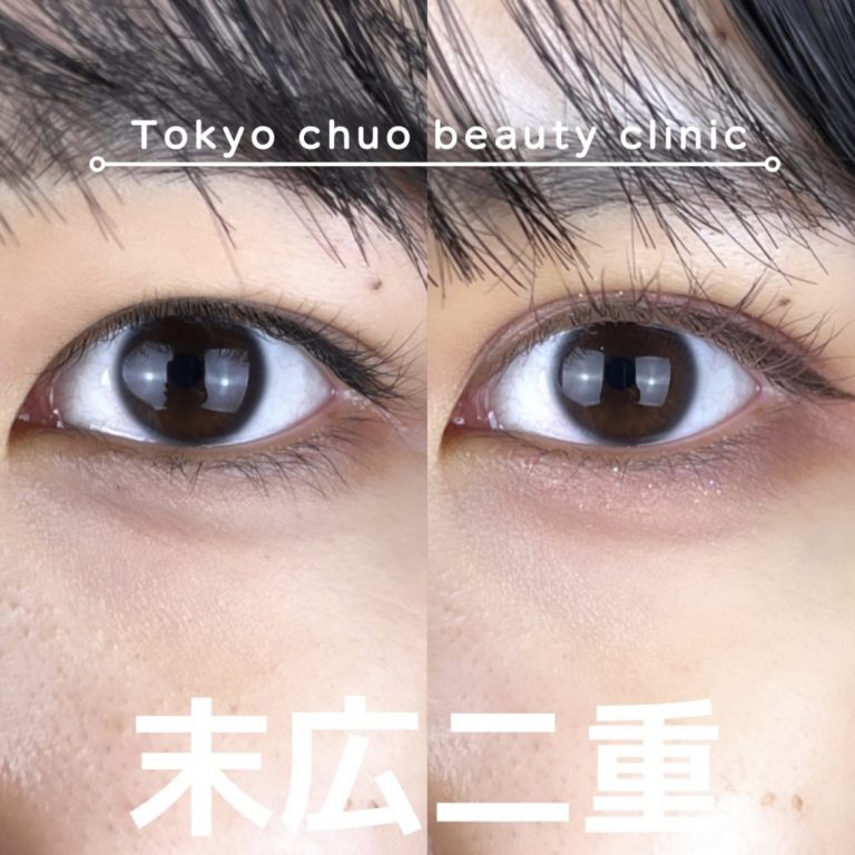 二重埋没法(担当医:TCB 医師)の症例写真3