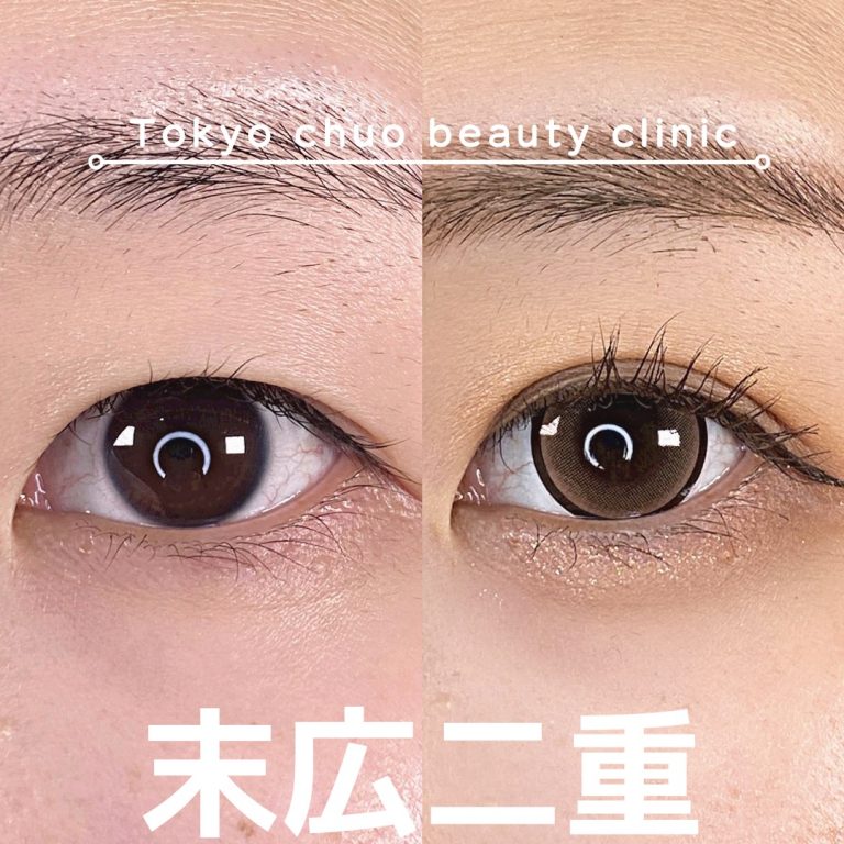 二重埋没法(担当医:TCB 医師)の症例写真3