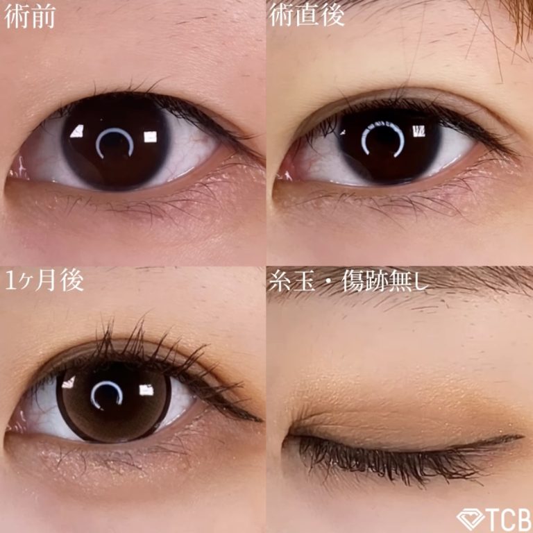 二重埋没法(担当医:TCB 医師)の症例写真1