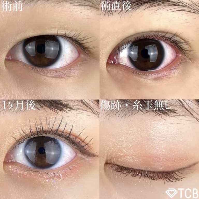 二重埋没法(担当医:TCB 医師)の症例写真1