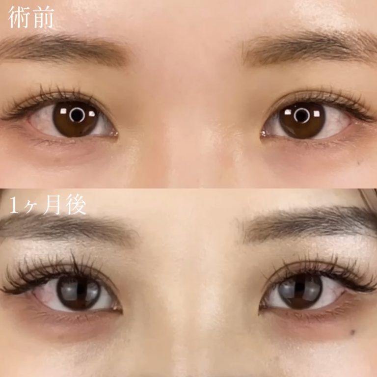 二重埋没法(担当医:TCB 医師)の症例写真3