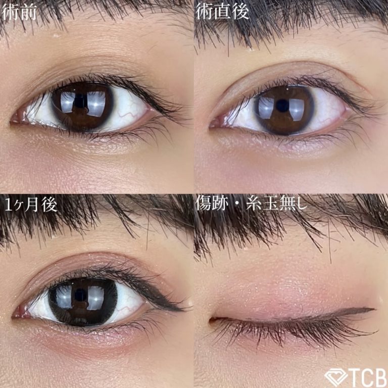 二重埋没法(担当医:TCB 医師)の症例写真1