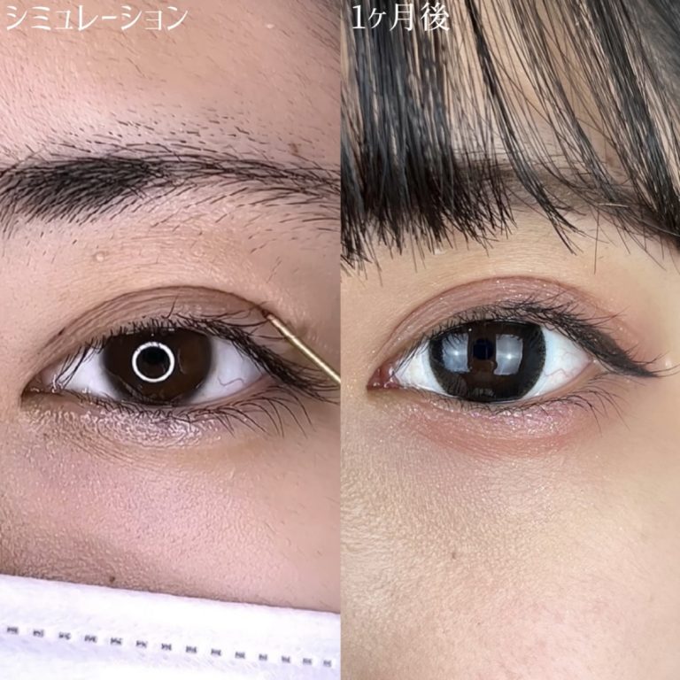 二重埋没法(担当医:TCB 医師)の症例写真3
