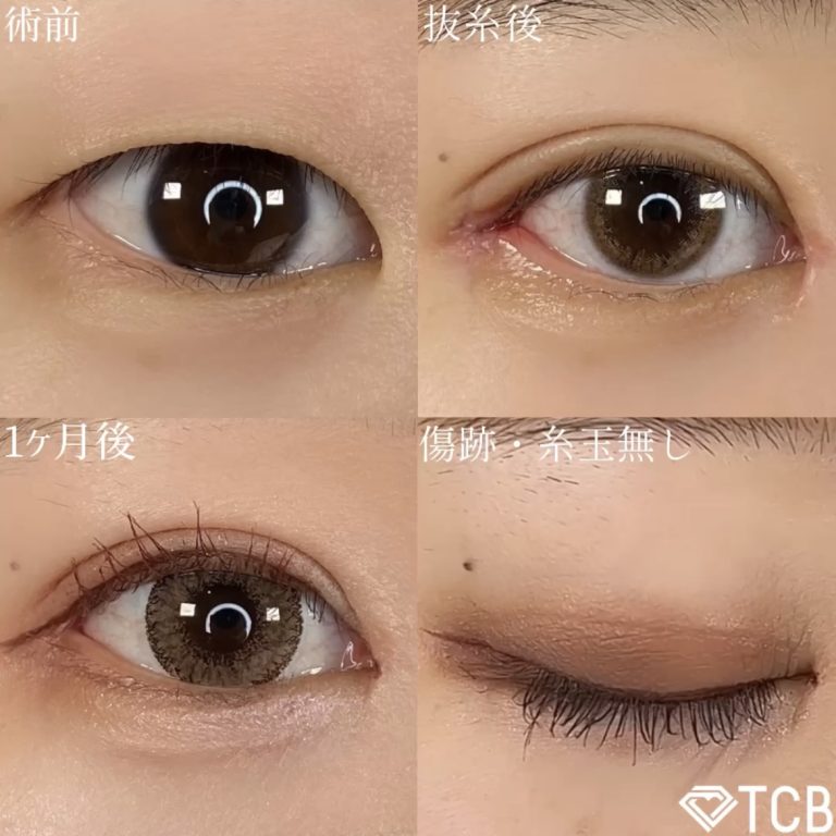 二重埋没法(担当医:TCB 医師)の症例写真1