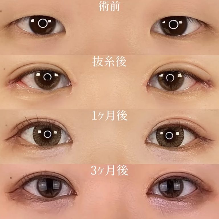 二重埋没法(担当医:TCB 医師)の症例写真2