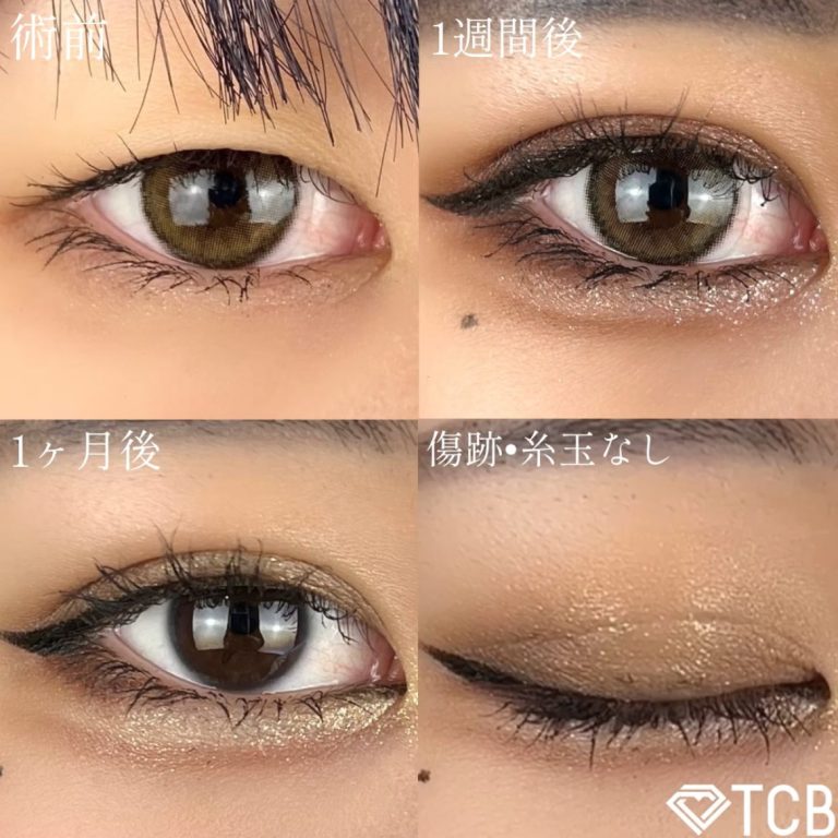 二重埋没法(担当医:TCB 医師)の症例写真1