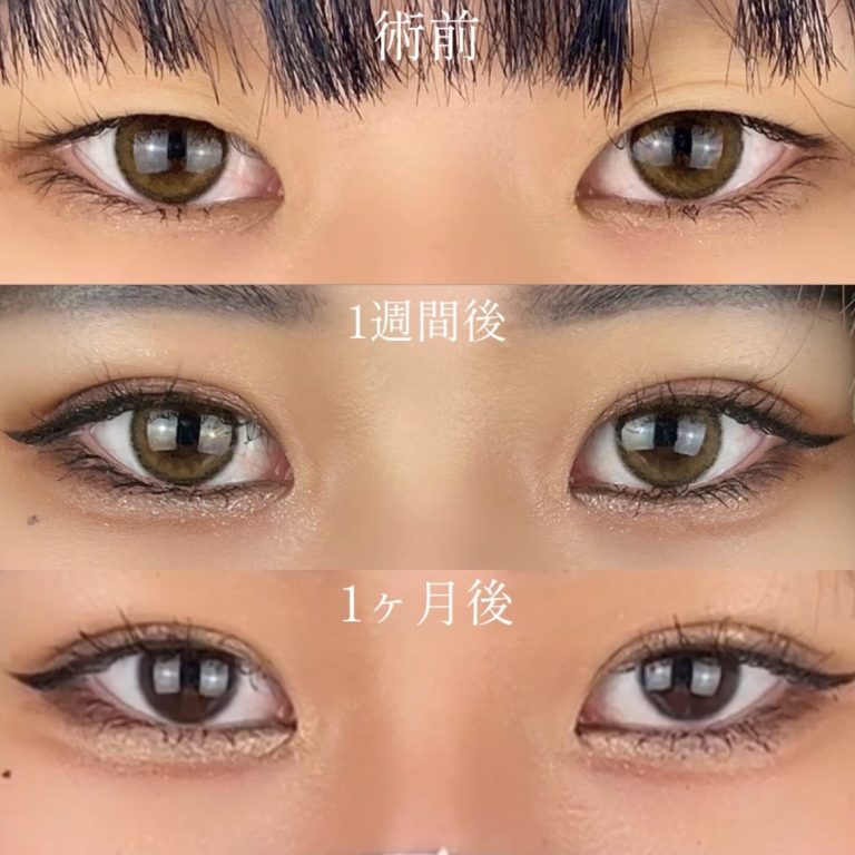 二重埋没法(担当医:TCB 医師)の症例写真2