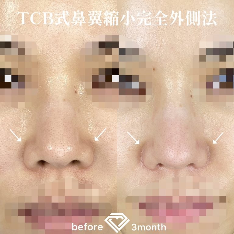 TCB式鼻翼縮小完全内側法(担当医:森本 理一郎 医師)の症例写真1