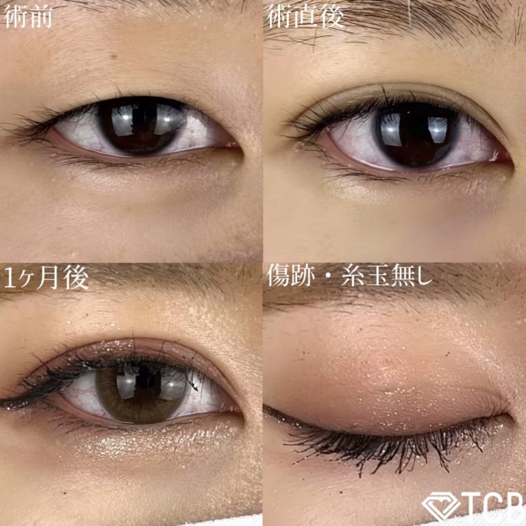 二重埋没法(担当医:TCB 医師)の症例写真1