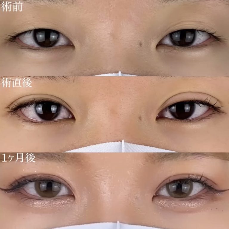 二重埋没法(担当医:TCB 医師)の症例写真2