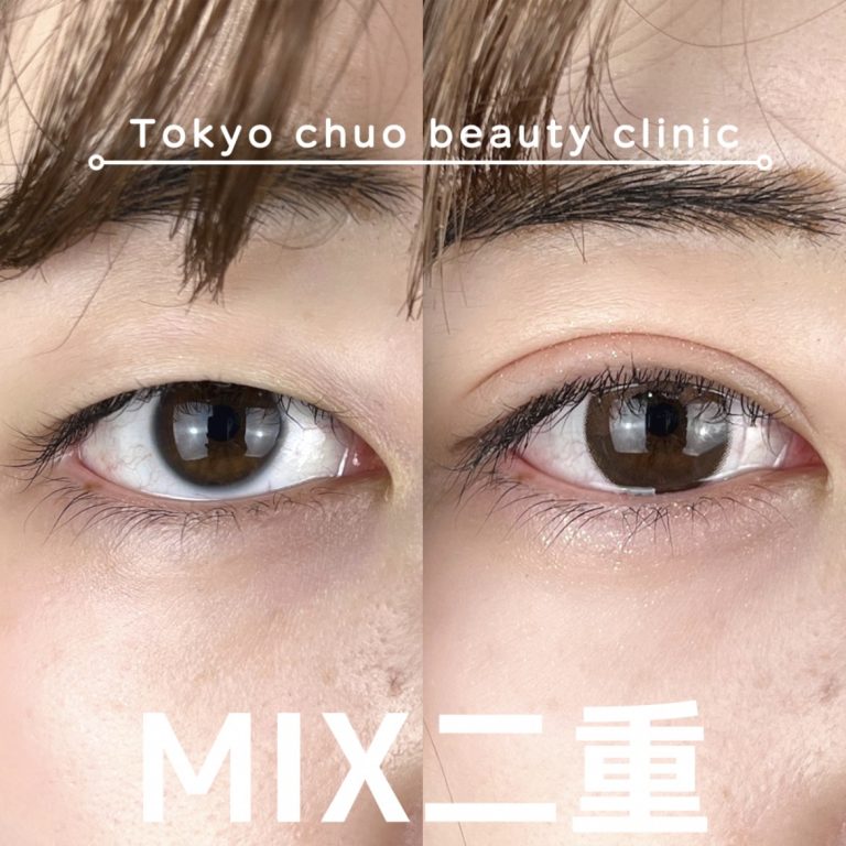 二重埋没法(担当医:TCB 医師)の症例写真1