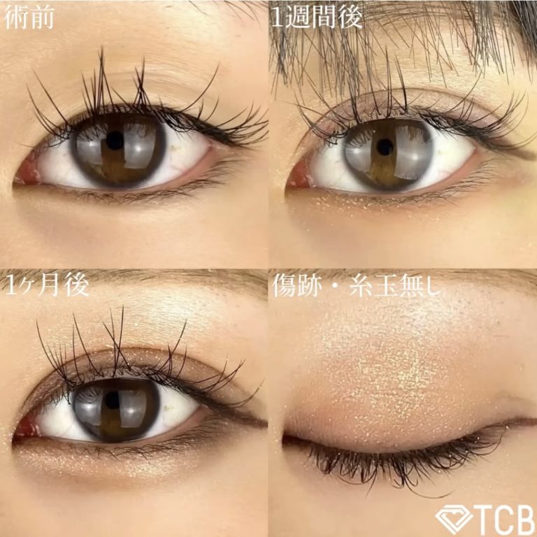 二重埋没法(担当医:TCB 医師)の症例写真1