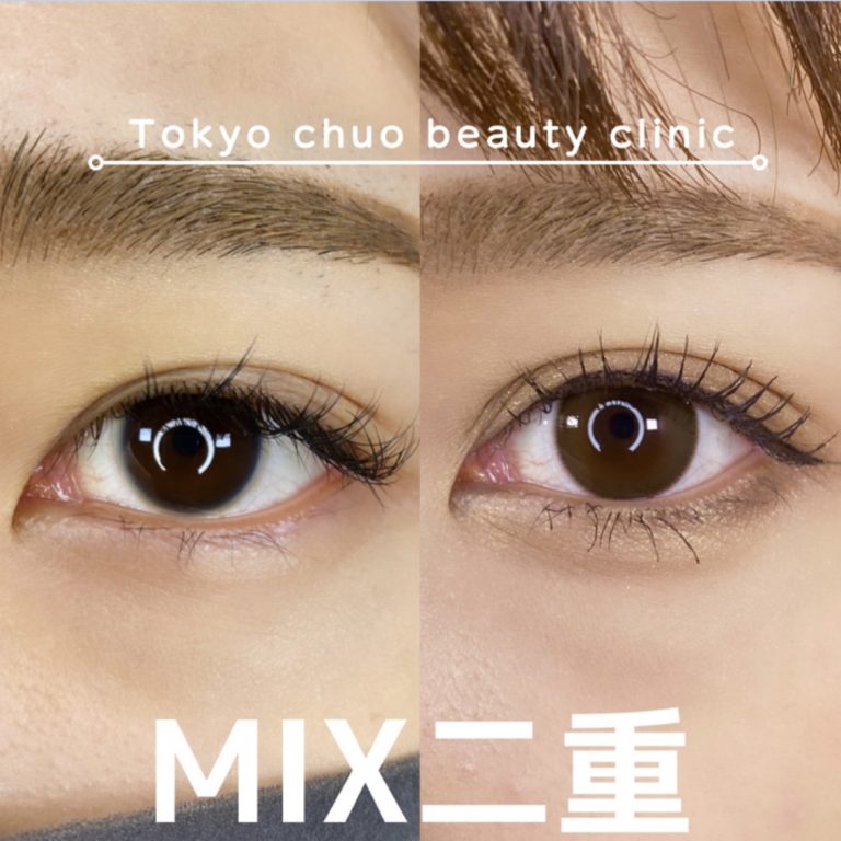 二重埋没法(担当医:TCB 医師)の症例写真3
