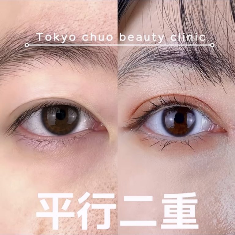 二重埋没法(担当医:TCB 医師)の症例写真1