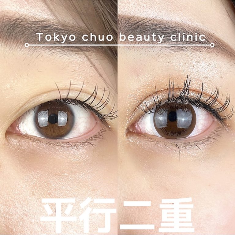 二重埋没法(担当医:TCB 医師)の症例写真1