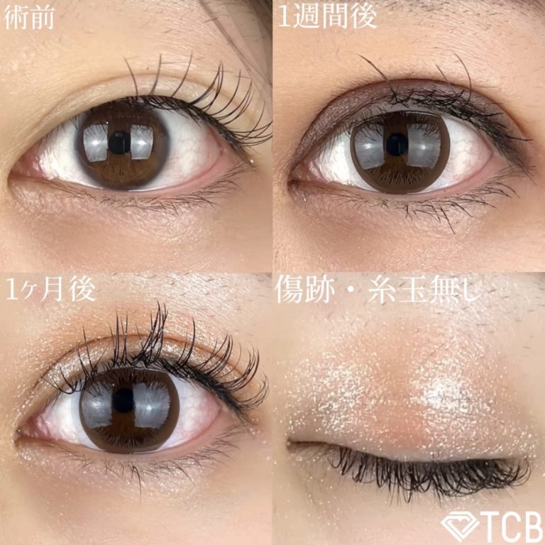 二重埋没法(担当医:TCB 医師)の症例写真3
