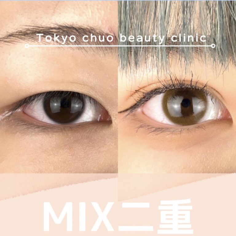 二重埋没法(担当医:TCB 医師)の症例写真1