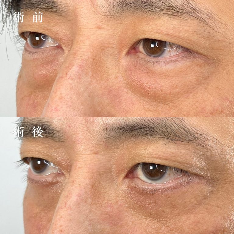 切開法による目の下のたるみ取り（下眼瞼除皺術）(担当医:真鍋 秀明 医師)の症例写真2