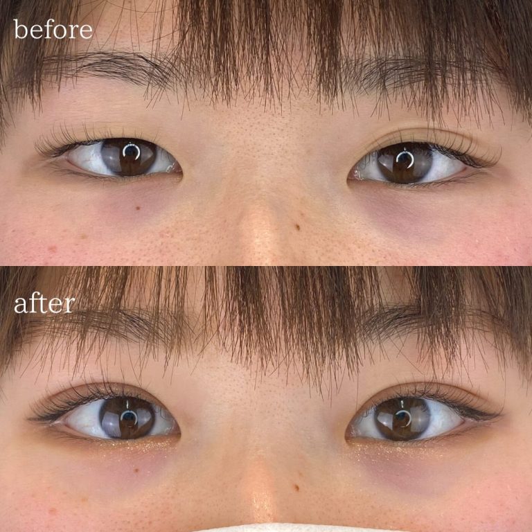 二重埋没法(担当医:TCB 医師)の症例写真1