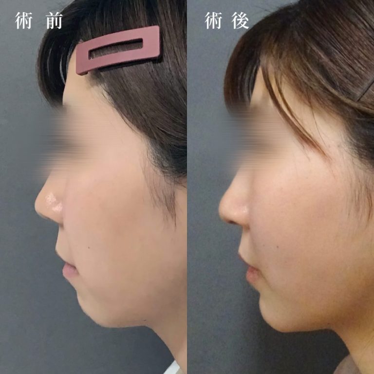 切らない顎形成 3D Eライン(担当医:真鍋 秀明 医師)の症例写真2