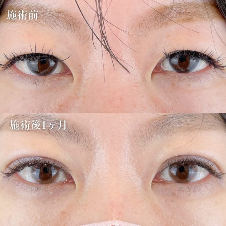 二重埋没法(担当医:TCB 医師)の症例写真2